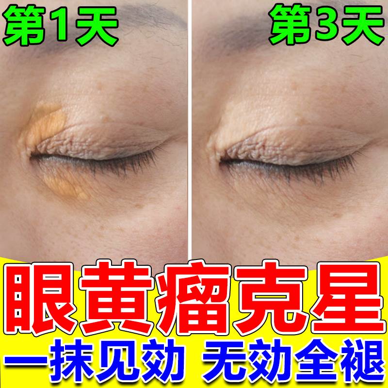 眼脸黄瘤膏去除睑黄疣药膏眼脸黄色瘤祛眼角部疣斑汗管瘤专用神器
