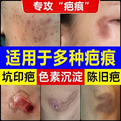 日本祛疤膏去疤痕修复除疤膏医用硅酮凝胶剖腹产烫伤增生凸起疙瘩
