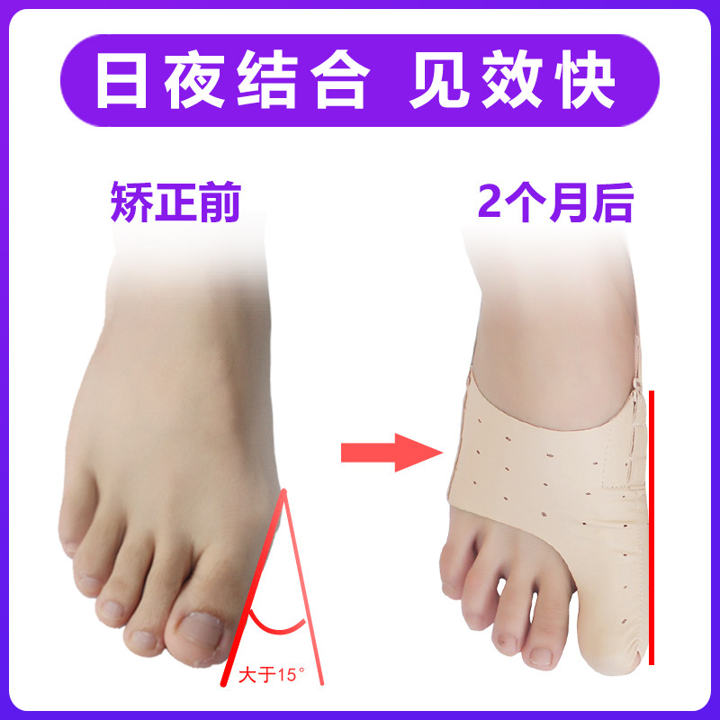 医院同款拇指外翻矫正器女大脚骨脚趾分趾器儿童拇趾分离器可穿鞋