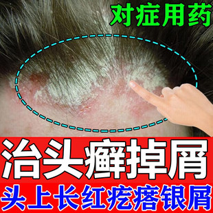 头癣药膏治头皮癣头部红斑瘙痒真菌感染结痂屑硝酸咪康唑乳膏正品