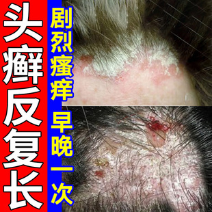 头癣药膏治头皮癣头部红斑瘙痒真菌感染结痂屑硝酸咪康唑乳膏正品