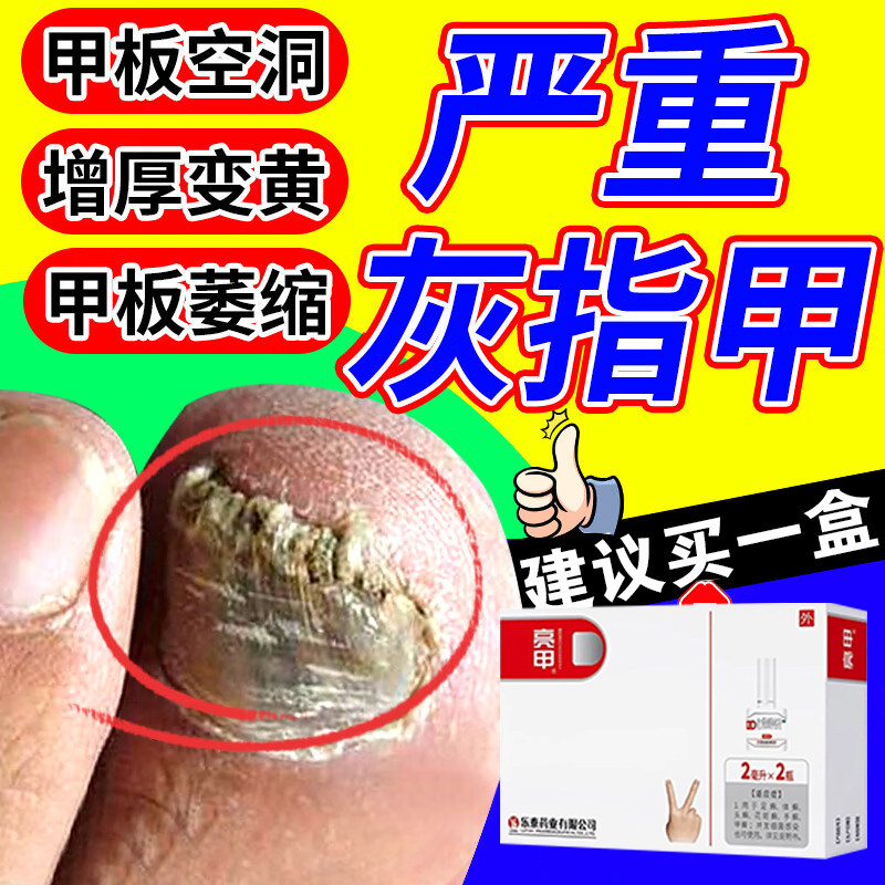 亮甲灰指甲专用灰指甲特重度效专用指甲真菌感染增厚发黄变厚变色