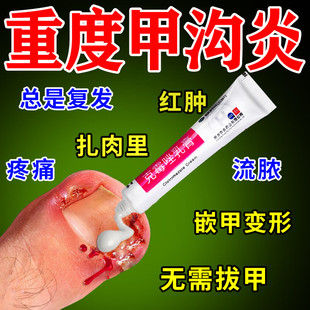 甲沟炎专用药治疗专用特新效期药膏脚大拇指甲沟炎软化息肉去除