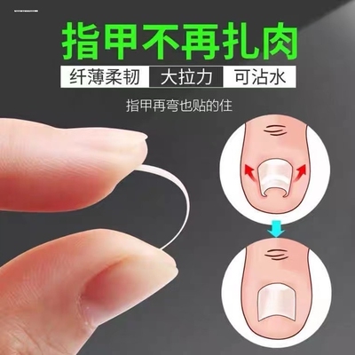 甲沟矫正器指甲矫正嵌甲神器纠正器脚趾甲贴片卷曲甲专用正甲扣炎
