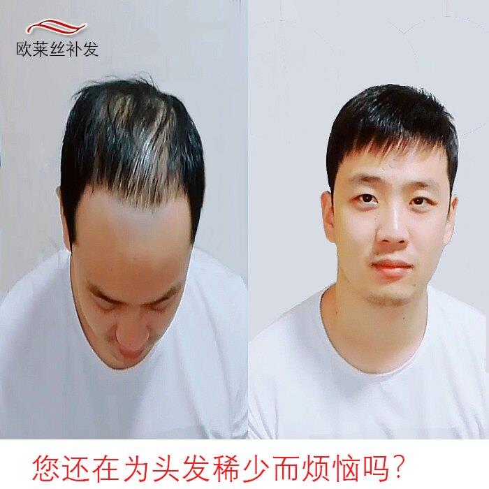 西安补发织发片真人假发仿生头皮发块生物隐假发真发男士假发逼真