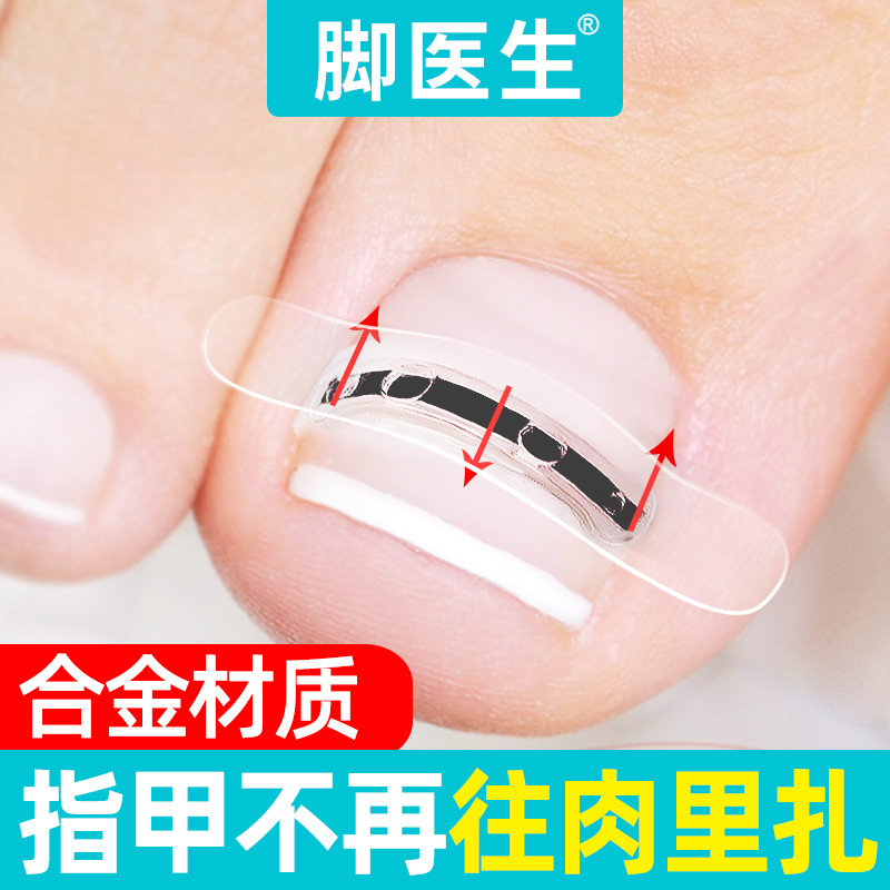 脚医生甲沟嵌甲矫正器炎正甲贴贴片脚趾指甲往肉里长专用指甲