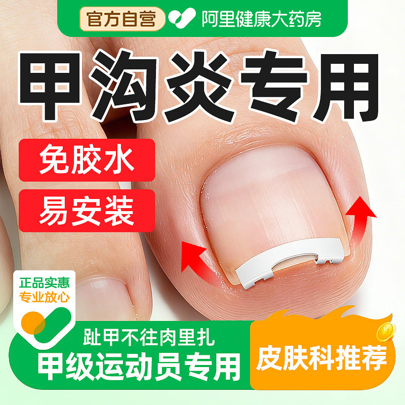 甲沟矫正器嵌甲矫正器脚趾甲卷指甲纠正神器正甲扣拉拉炎正甲贴片