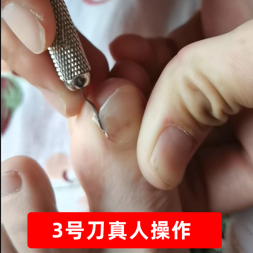 德国嵌甲修甲刀甲沟炎U修脚刀好