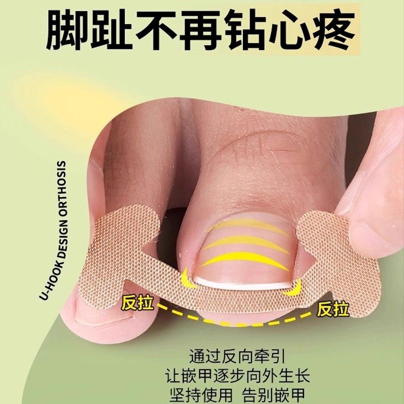 甲沟神器指甲矫正器隔离脚趾