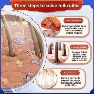 毛囊炎中药洗发香波头皮毛囊炎专为痤疮和发痒的头皮和丘疹霜