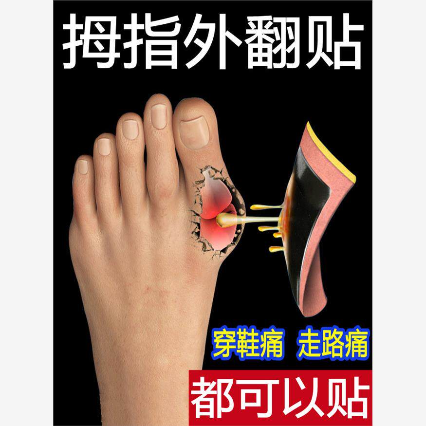 拇囊疼痛炎拇指外翻膏药贴大脚骨外翻脚趾疼痛畸形肿胀特矫正效贴
