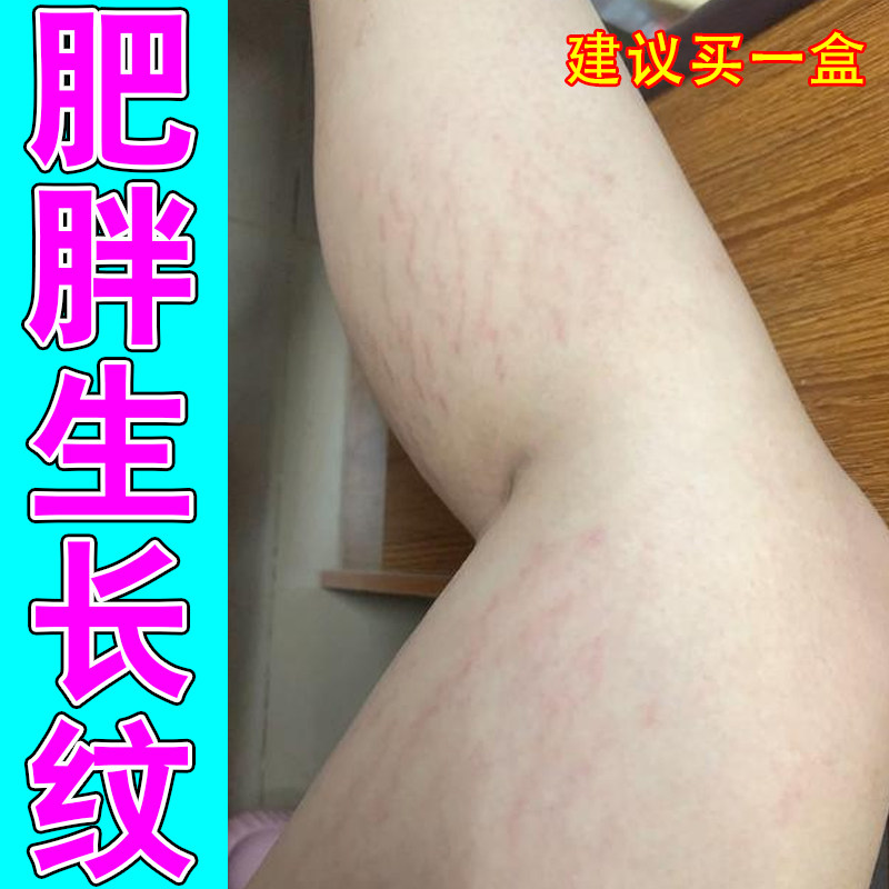 去除肥胖纹生长纹腿部肥胖纹严重肥胖纹祛除胖子去妊娠纹