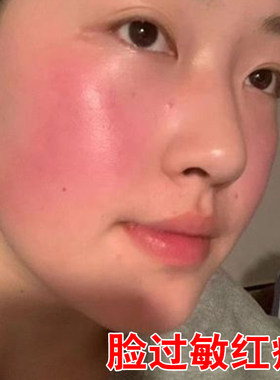 脸红发烫发热一热脸红脸部泛红刺痛脸发红发烫红脸蛋发热敏感肌