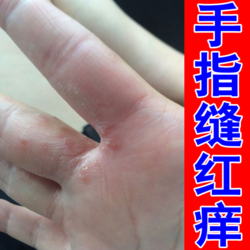 手指缝红痒手部皮肤红肿过敏季节皮肤消毒护理（消）