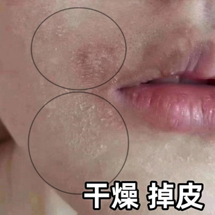 脸上起皮干皮脸上干燥脱皮泛红脸部干痒爆皮起皮掉皮皮肤粗糙卡粉