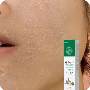 脸上长痒脸上痒面部脸痒脸部过敏脸痒干痒脸上起皮干燥脸干掉皮药