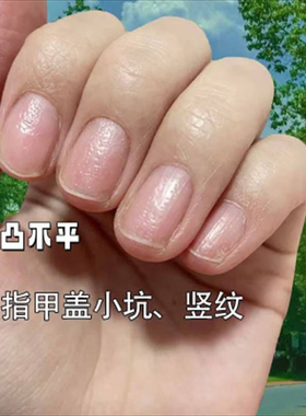 指甲黑色竖纹黑线手指甲真菌感染指甲有黑线手指甲护理手指甲修复