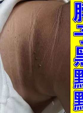去脖子黑皮脖子粗糙脖子黑色素沉淀黑黑的洗不干净