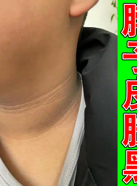 脖子黑粗糙洗不干净色素沉淀淡化黑色素