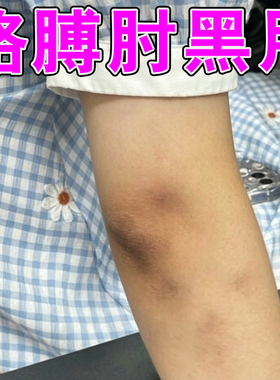 手肘黑黑的去除膏去胳膊肘黑色素沉淀去除死皮