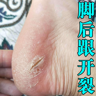 脚后跟干裂起硬皮足跟开裂手足脚底裂口子疼痛防裂修复霜