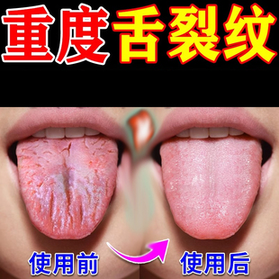 舌头中间有裂纹齿痕舌苔白厚调理舌头开裂灼烧感舌喷雾
