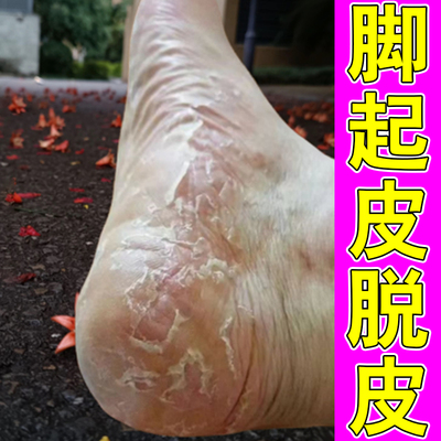 脚脱皮真菌感染脚底板脚心脚底干燥起皮蜕皮脚痒脚后跟干裂专用膏