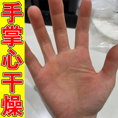 手掉皮专用膏手裂口专用蜕皮手指干燥起皮干裂修复