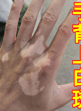 冶手背白斑的膏修复促进黑色素生长专用手上长白斑块