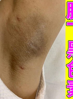去腋下去黑膏腋下去黑腋窝除黑色素沉淀