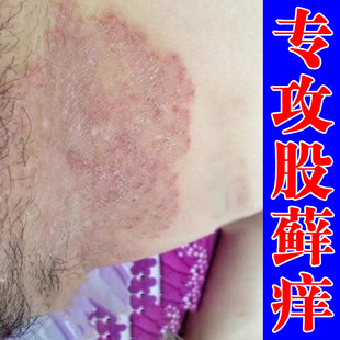 大腿内侧痒男士私处长小疙瘩腿部两侧燥粗糙痒