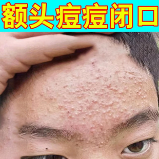 额头上长疙瘩闭口粉刺起小疙瘩淡化学生去豆豆疙瘩药软膏