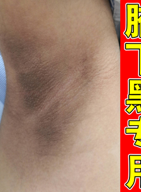 腋下去黑黑的色素沉淀腋窝黑色素沉淀去淡化