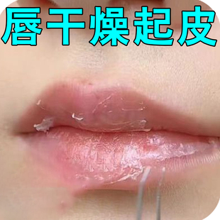 嘴唇干裂起皮总想撕嘴皮嘴唇干裂润唇膏