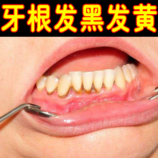 牙根发黑发黄牙菌斑牙斑净氟斑牙洗牙齿污垢牙黄牙垢