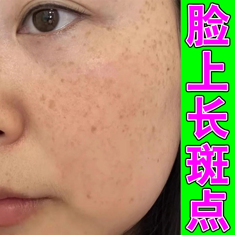 手上褐色斑点皮肤上长小黑点点脸上晒斑皮肤上有褐斑修护膏