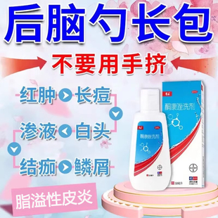 康王酮康唑洗剂50ml脂溢性皮炎头皮屑头皮糠疹花斑癣头皮痒洗发剂