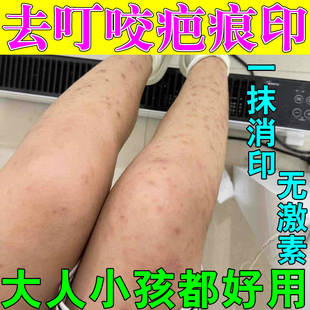 祛蚊虫叮咬疤膏去跳蚤蚊子叮咬疤痕腿上淡化黑色素修复腿挠印痘印