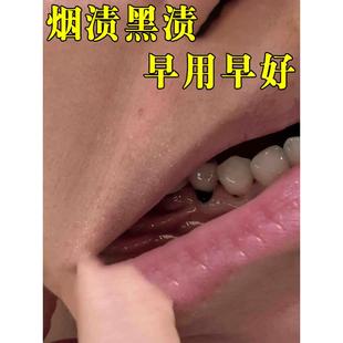 牙根发黑牙黄牙垢清除神器牙烟渍黑渍茶渍牙菌斑祛除牙缝黑洗牙粉