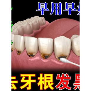 牙根发黑去除牙垢牙菌斑牙烟渍牙斑净去牙缝发黑清理神器氟斑牙药