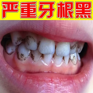 牙斑净去牙缝发黑清理神器除牙根黑斑黄牙黑牙垢烟渍茶渍洁白牙齿