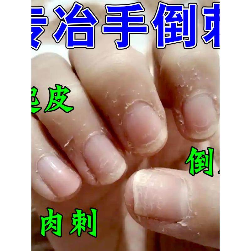 手指倒刺营养油儿童修覆