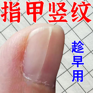 指甲竖纹营养不良甲分离空甲指甲指甲受损甲面凹凸不平开裂专用液