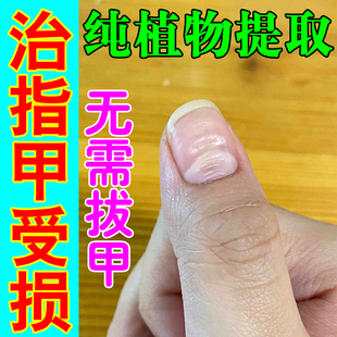 受损指甲凹陷变形手脚指甲凹凸不平修复萎缩开裂竖纹空甲发黄分层