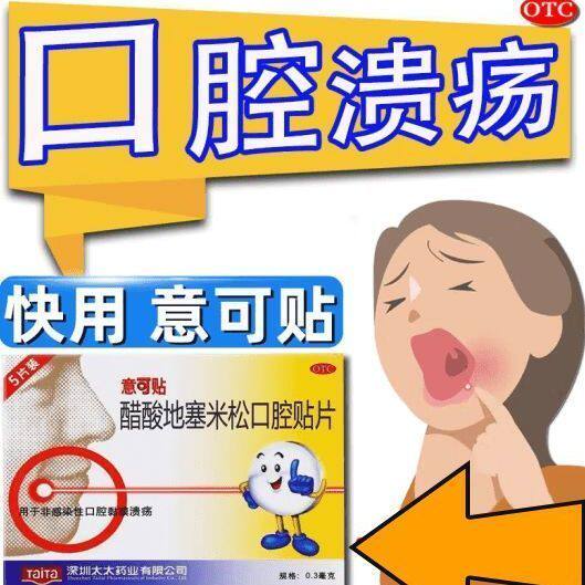 【意可贴】醋酸地塞米松口腔贴片0.3mg*5片/盒