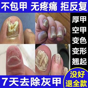 灰指甲脱甲膏专用正品抑菌液甲沟炎灰趾甲剪刀去除厚脚指甲软化剂