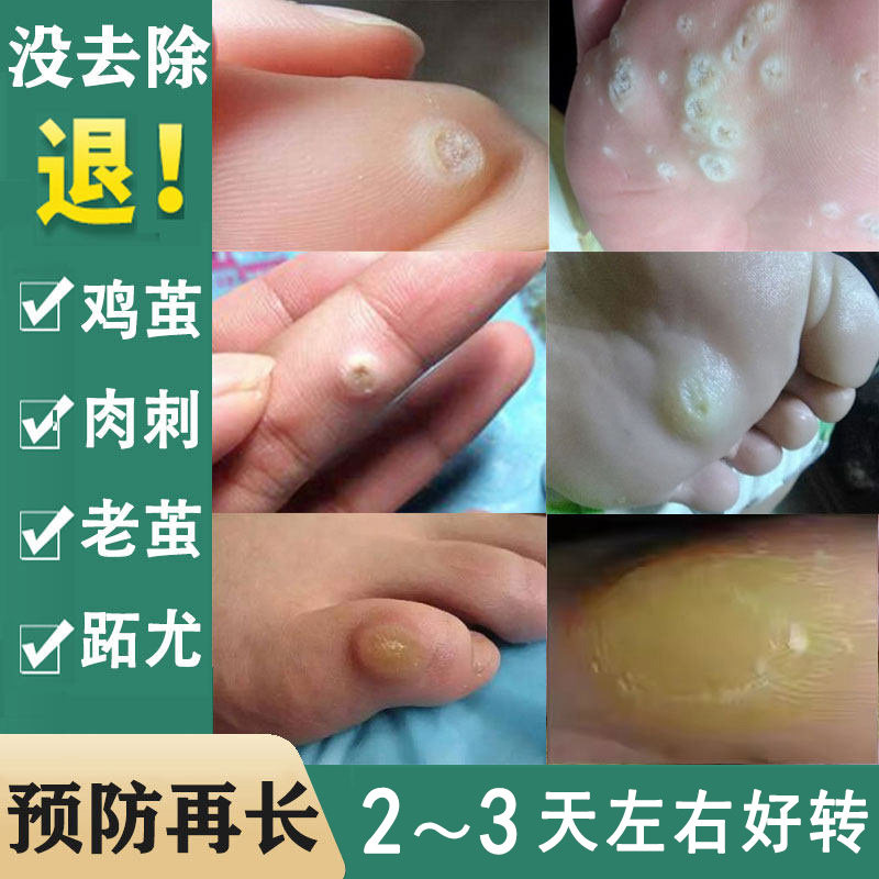 足底跖疣专用膏手上长老茧去除软化剂小脚趾脚底鸡眼贴鸡眼膏肉刺