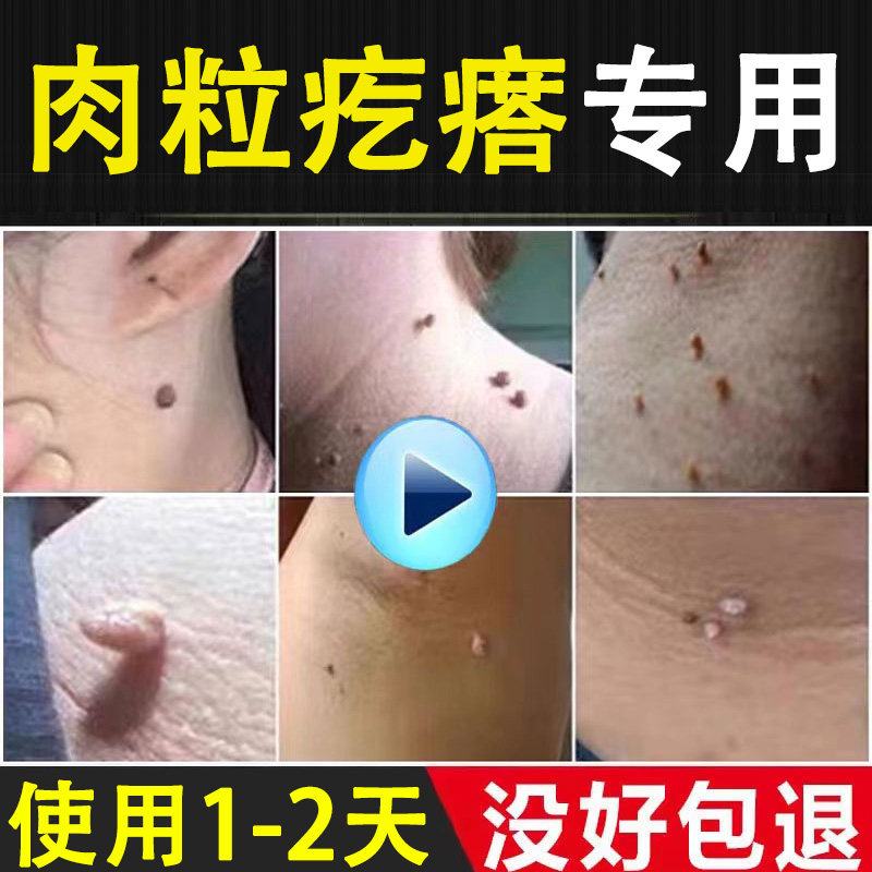 祛脖子上长的小肉粒疙瘩扁平疣颈部腋下点尤丝状疣软疣瘊子去除膏