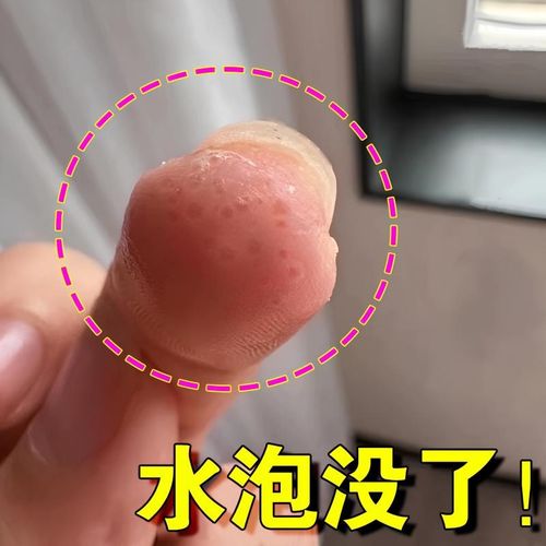 【 手上起小水泡l】汗状疱疹止痒汉状真菌感染根去汗泡疱克星