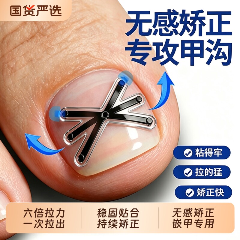 甲沟矫正器脚指甲往肉里长专用正甲贴片嵌甲矫正趾甲扎肉工具专业